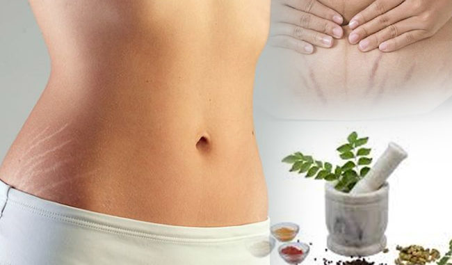 स्ट्रेच मार्क्स दूर करने के घरेलु नुस्खे